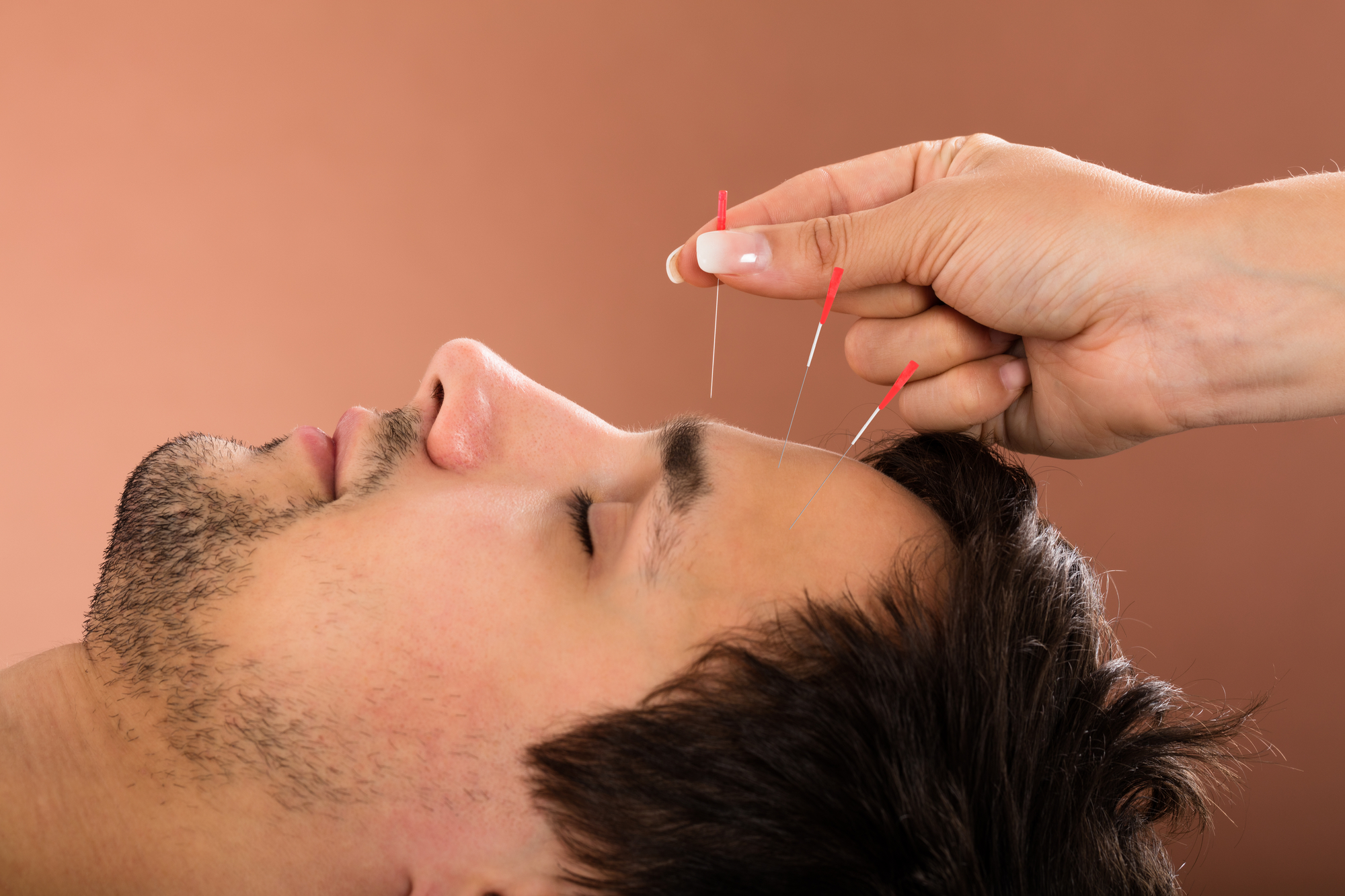 man getting accupuncture treatment in forehead